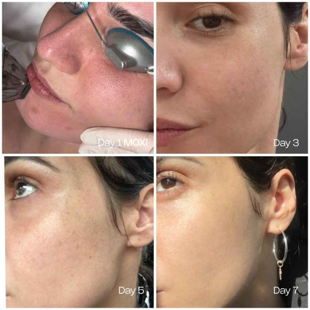 Before and after treatment result 4 — TEUTÉ Advanced Aesthetics, Prishtina